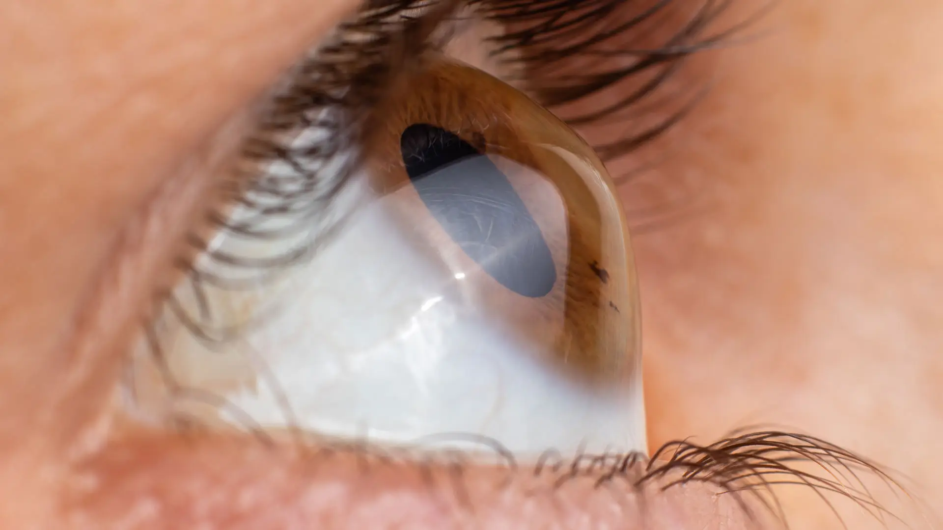 Mapeo del Espesor y Seguridad Corneal